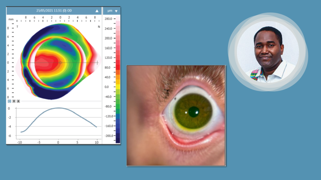 Nystagmus Eyes - Need for Speed