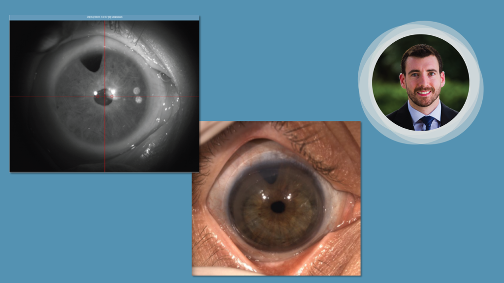 Unique scleral lens fitting for Buphthalmos