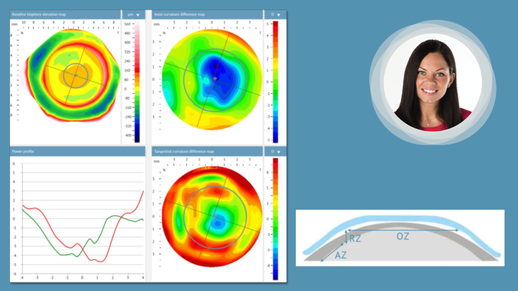 Profilometry Based Orthokeratology by Dr. Sheila Morrison